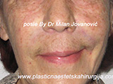 After Face fillers