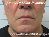 Before Face fillers