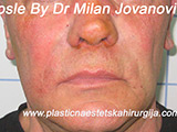 After Face fillers