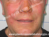 After Face fillers