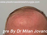 Before hair transplantation Before hair transplantation