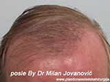 Results after one year after hair transplantation Results after one year after hair transplantation
