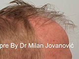 Before hair transplantation Before hair transplantation