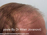 Results after one year after hair transplantation Results after one year after hair transplantation