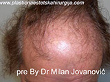 Before hair transplantation Before hair transplantation