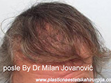 Results after one year after hair transplantation Results after one year after hair transplantation