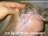 Before hair transplantation Before hair transplantation