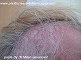 Results after two years after hair transplantation Results after two years after hair transplantation