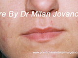Before lip augmentation