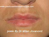 After lip augmentation