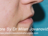 Before lip augmentation