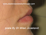 After lip augmentation