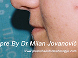 Before lip augmentation