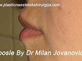 After lip augmentation