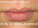 Before lip augmentation