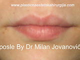 After lip augmentation