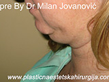 Result before liposuction