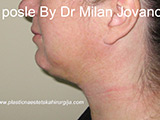 Result after liposuction