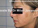 Two weeks after microdermabrasion Two weeks after microdermabrasion
