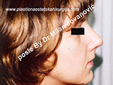 After nose surgery After nose surgery