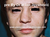 Before nose surgery Before nose surgery