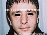 After nose surgery After nose surgery