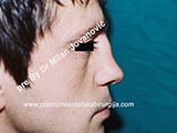 Before nose surgery Before nose surgery