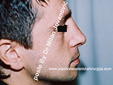 After nose surgery After nose surgery