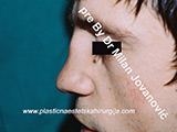 Before nose surgery Before nose surgery