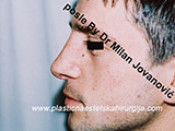 After nose surgery After nose surgery