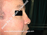 Before nose surgery Before nose surgery
