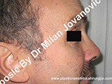 After nose surgery After nose surgery