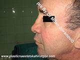 Before nose surgery Before nose surgery