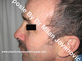 After nose surgery After nose surgery