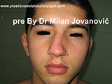 Before nose surgery Before nose surgery