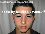 After nose surgery After nose surgery