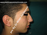 Before nose surgery Before nose surgery