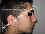 After nose surgery After nose surgery