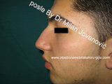 Before nose surgery Before nose surgery