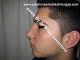 After nose surgery After nose surgery