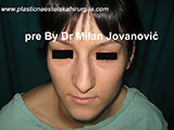 Before nose surgery Before nose surgery