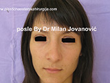 After nose surgery After nose surgery