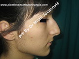 Before nose surgery Before nose surgery