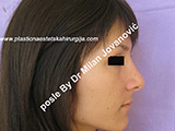 After nose surgery After nose surgery