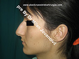 Before nose surgery Before nose surgery