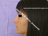 After nose surgery After nose surgery