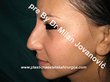 Before nose surgery Before nose surgery