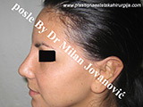 After nose surgery After nose surgery