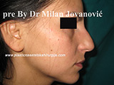 Before nose surgery Before nose surgery