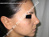 After nose surgery After nose surgery